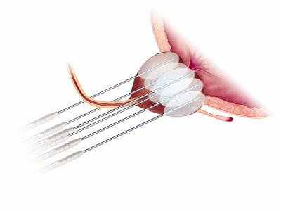 Cryoablation probes inserted transperineally into the prostate forming ice balls — the freeze-and-thaw mechanism Dr. Wei Phin Tan uses to destroy prostate cancer cells while sparing surrounding tissue