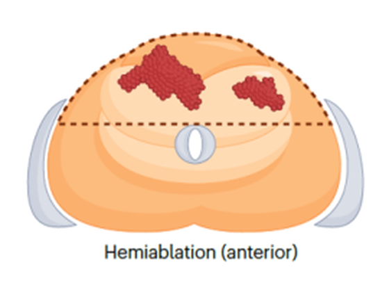 Anterior hemiablation cryoablation pattern — entire anterior half of the prostate treated, axial view
