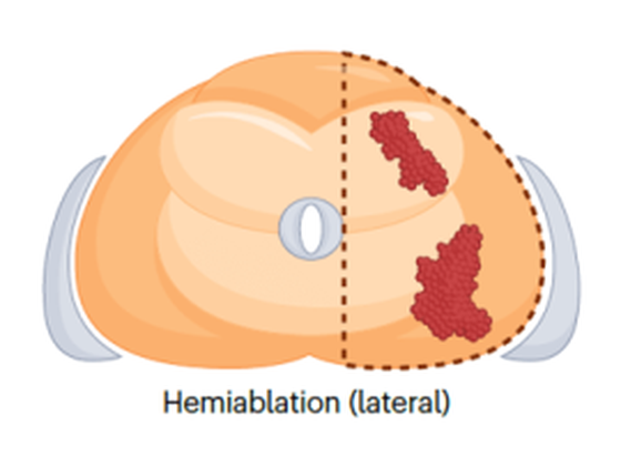 Lateral hemiablation cryoablation pattern — entire left or right half of the prostate treated, axial view