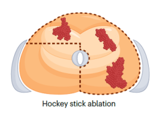 Hockey-stick cryoablation pattern — L-shaped treatment combining anterior and lateral coverage, axial view of prostate
