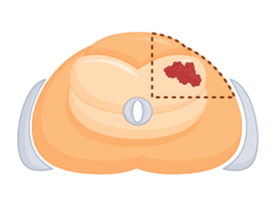 Quadrant cryoablation — single anterolateral quadrant treated, dashed ablation boundary, axial view of prostate