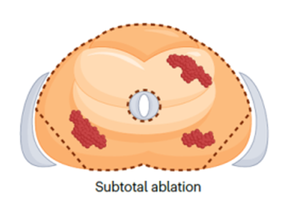 Subtotal cryoablation pattern — most of the gland ablated while sparing neurovascular bundle, axial view of prostate