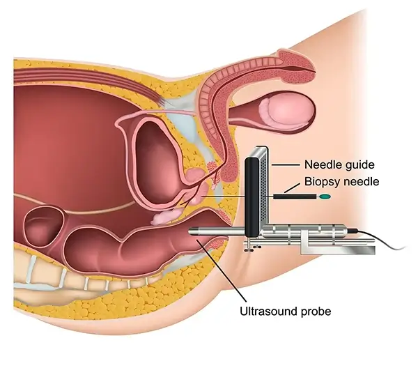 Anatomical diagram of transperineal prostate biopsy — ultrasound probe, needle guide, and biopsy needle entering through the perineum, avoiding the rectum